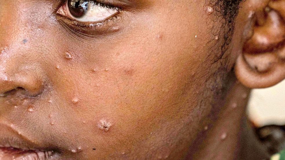 Derzeit ist Mpox vor allem in der Demokratischen Republik Kongo ein großes Problem. Foto: dpa/AP/Moses Sawasawa